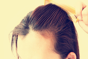 脱发了该怎么办 头发加密技术是有效治疗方法