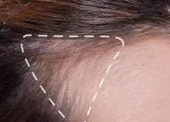 发际线植发怎么麻醉 发际线植发是**的吗