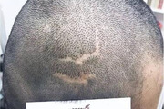 疤痕性脱发怎么办 疤痕植发的效果好不好