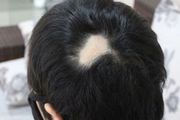 疤痕部位毛发种植的效果怎么样？