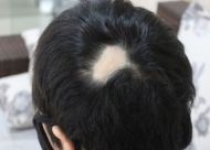 疤痕部位毛发种植的效果怎么样？