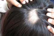 斑秃的治疗方法有哪些？及病因有哪些