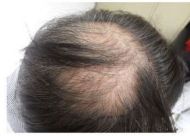 头发移植的常见问题有哪些？