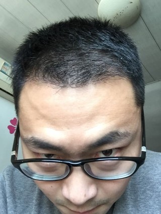 发际线怎么样_术后第165天效果图_假装狠辛福的植发日记第15页_求发网