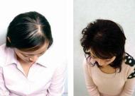 导致女性头发稀少的主要原因是什么？