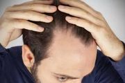 U型脱发形成的原因是什么？三种治疗u型脱发