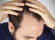 U型脱发形成的原因是什么？三种治疗u型脱发
