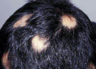 斑秃是怎么样形成的 疤痕性斑秃可以进行植发手术吗