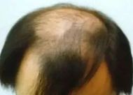 导致U型脱发原因有哪些？三种治疗方法摆脱脱发困扰