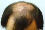 U型脱发产生的原因都有哪些?预防U型脱发的方法