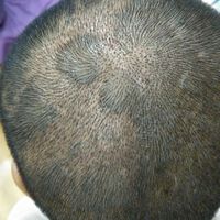疤痕植發(fā)用戶圖片