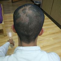 疤痕植發(fā)用戶圖片