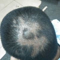 疤痕植發(fā)用戶圖片