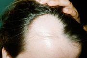 男性脂溢性脱发的原因是什么,两大治疗脱发方法