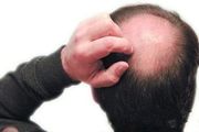 有什么方法可以改善男人秃顶？这三大方法有效果