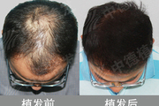 头发加密植发有用吗 头顶加密种植价位是多少