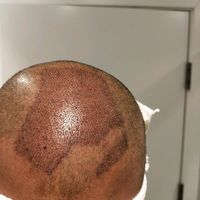 禿頂用戶圖片
