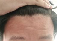 毛發(fā)種植的效果好不好？毛發(fā)種植的四大優(yōu)勢(shì)【推薦】