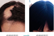如何去掉头部的疤痕 疤痕植发效果怎么样