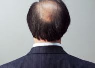 遗传性脱发一般从几岁开始  遗传性脱发的四大特点