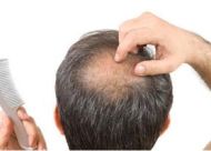 男性秃顶的原因：秃顶的六大因素