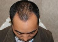 植发一般需要多少单位 脱发级别对应植发单位
