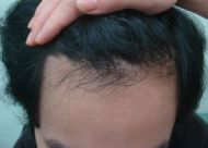 鲁尼植发：秃顶植发大概多少钱 术前术后的护理注意事项