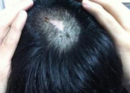 疤痕植发和普通植发有什么区别 疤痕植发效果怎样