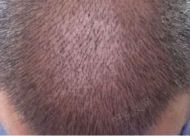 蛋白纤维植发能治疗脱发吗 六大优势靠谱