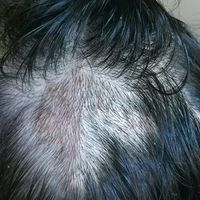 疤痕植發(fā)用戶圖片