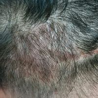 疤痕植發(fā)用戶圖片