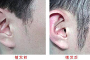 鬓角移植靠谱吗 移植的恢复时间多久