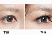 眉毛种植的毛囊是从哪里提取的 种植效果是永jiu的吗