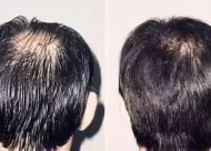 除脂生发片 头发加密植发会损伤原生发吗?
