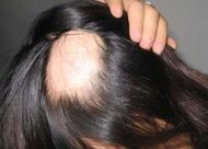 鬼剃头怎么治疗 三种因素导致斑秃的发生