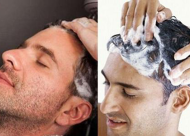 米诺地尔治疗脱发的原理是什么 使用注意事项有哪些