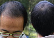 头发稀疏该怎么办呢  加密植发会不会留下疤痕呢
