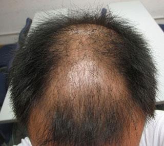 许多发友脱发都是从头顶部位开始脱发的,两侧以及后部的一圈还有头 
