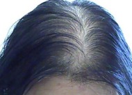 河南头发种植 种植头发后为什么会有脱落期？三个原因你要淡定