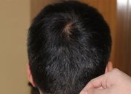 北京植信 植的头发真的会长出来吗？公认的两种植发技术