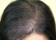 化学性脱发的因素有哪些?如何消除化学性脱发的烦恼?