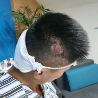 疤痕植發(fā)用戶圖片