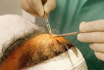 种植头发的价格影响因素有哪些?手术过程是怎样的?