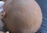 真发做的假发 男性秃头戴假发有危害吗