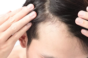 治疗脱发的偏方有什么?这五个民间小偏方了解起来!
