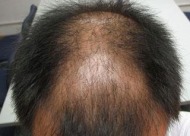 先天性头发稀疏怎么办 加密植发有用吗
