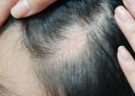 休止期脱发的症状有哪些？有哪些治疗方法