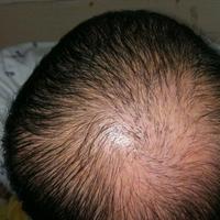 禿頂用戶圖片