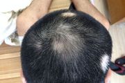 先天性脱发怎么治疗？教你比较的三种护理方法