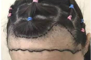 植入头发多少钱 植发以后的注意事项有哪些